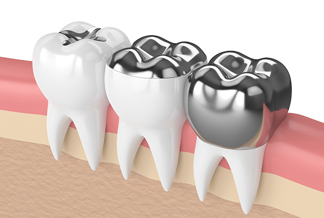 歯の内部まで進行したむし歯の治療方法